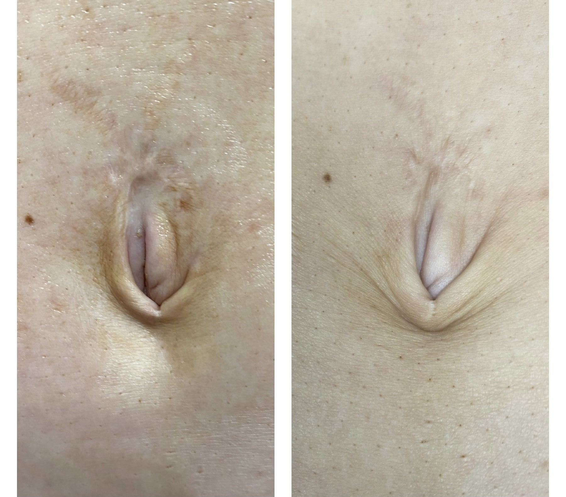 Stretch Mark Removal