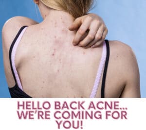 back acne Bella Lei Aesthetics