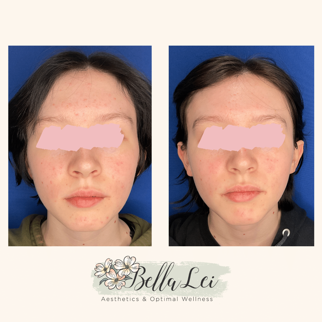 help acne bella lei fleming island