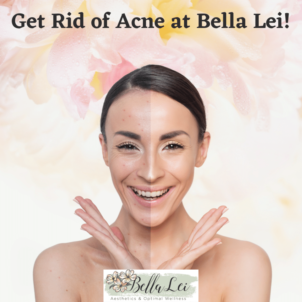 get rid of acne at Bella Lei