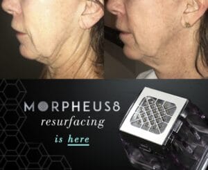 morheus8 microneedling bella lei