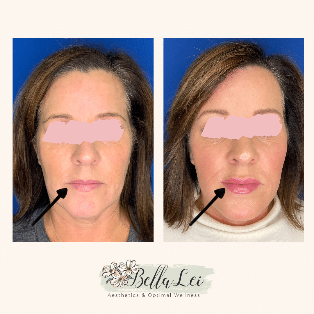 lip fillers bella lei fleming island fl