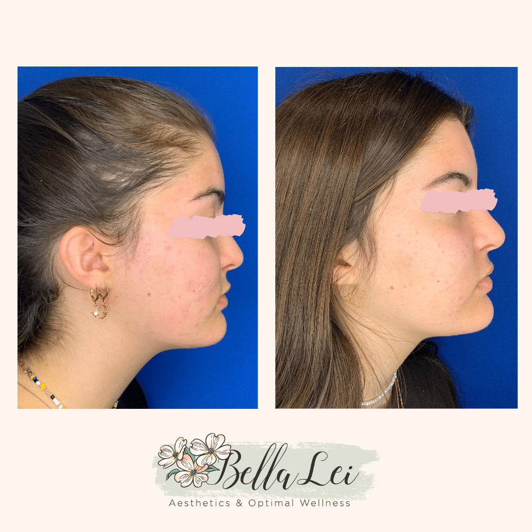 get rid of acne bella lei fleming island