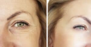 before and after zo intense eye cream