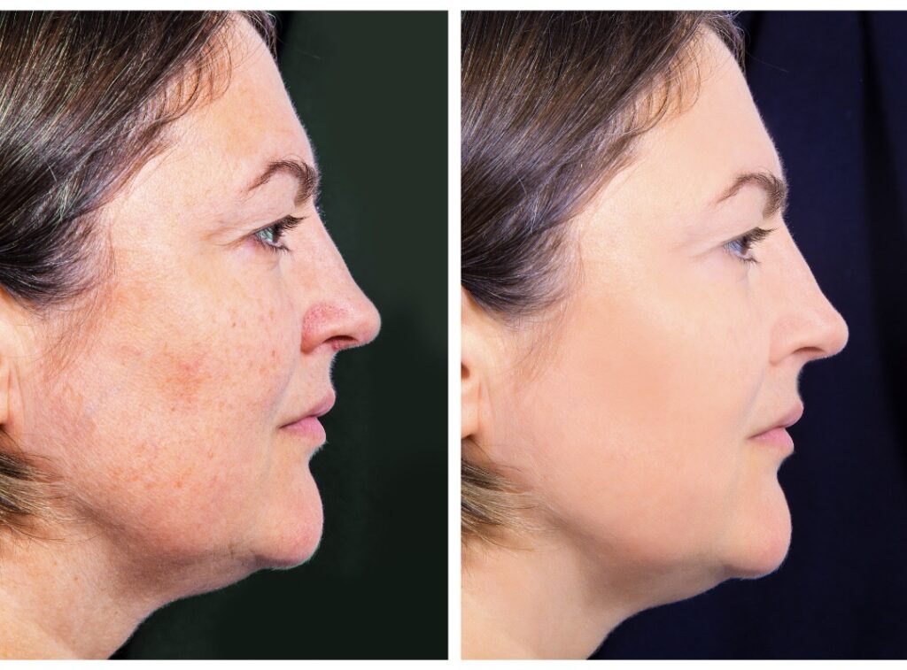 laser treatment before and after