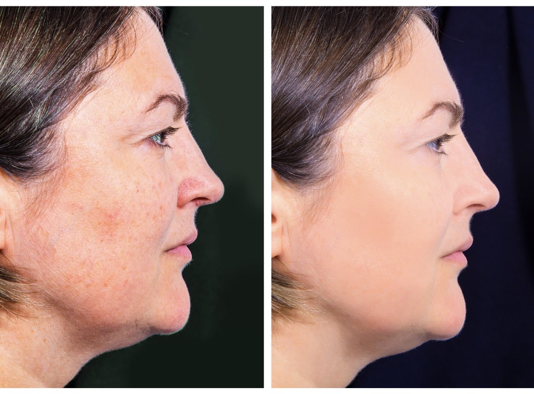 Side-by-side profile photos of a woman showing her facial skin before and after a cosmetic treatment; the left image displays uneven skin tone and texture, while the right shows smoother, clearer skin. Bella Lei Aesthetics and Wellness - Flemming Island, Florida