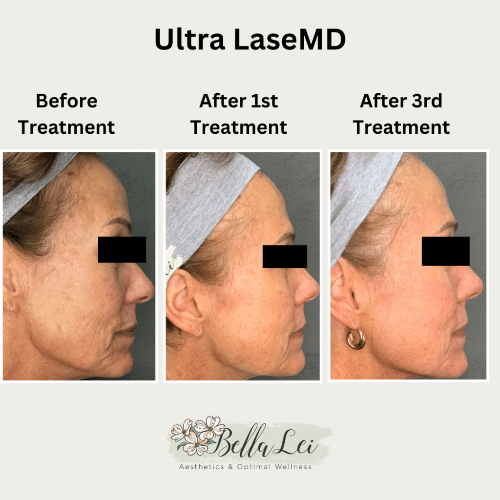 facial laser treatment bella lei fleming island florida