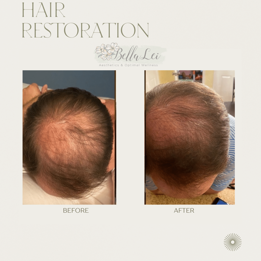 Before and Afters hair restoration bella lei