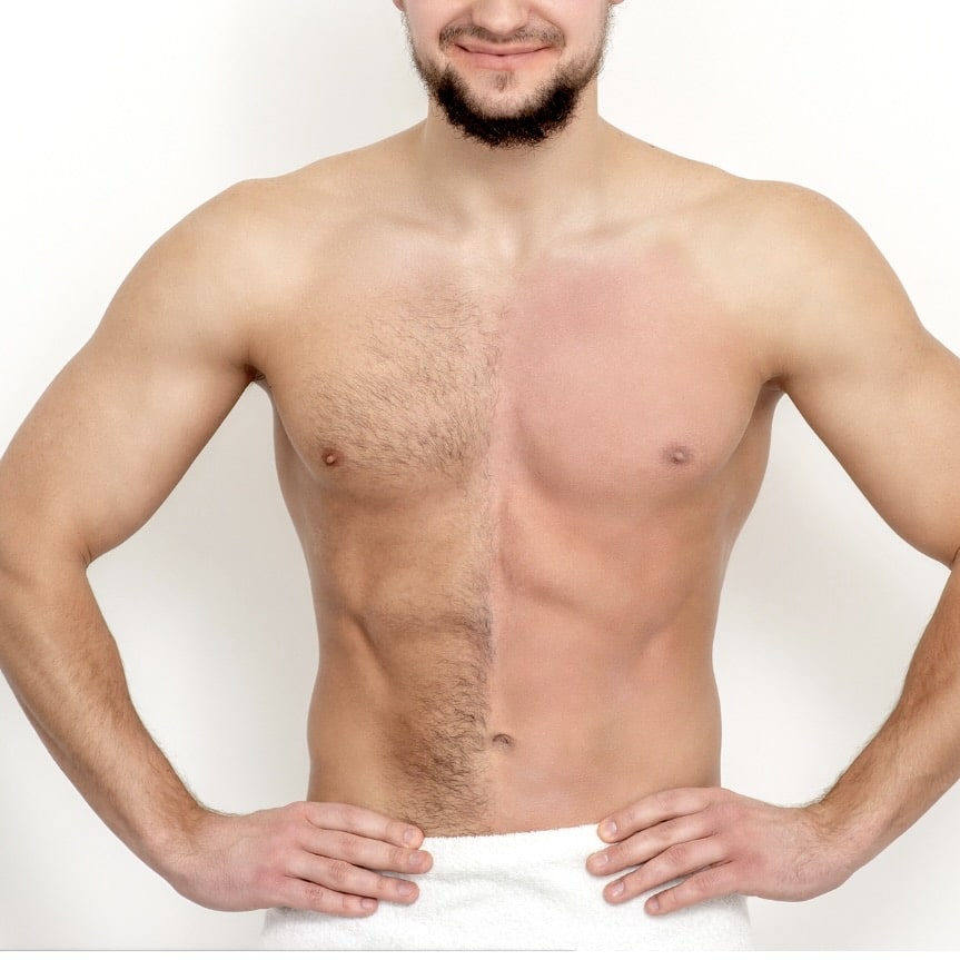 Laser Hair Removal for men