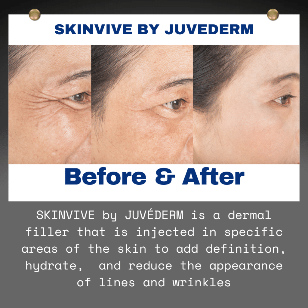 Skinvive by juvederm 