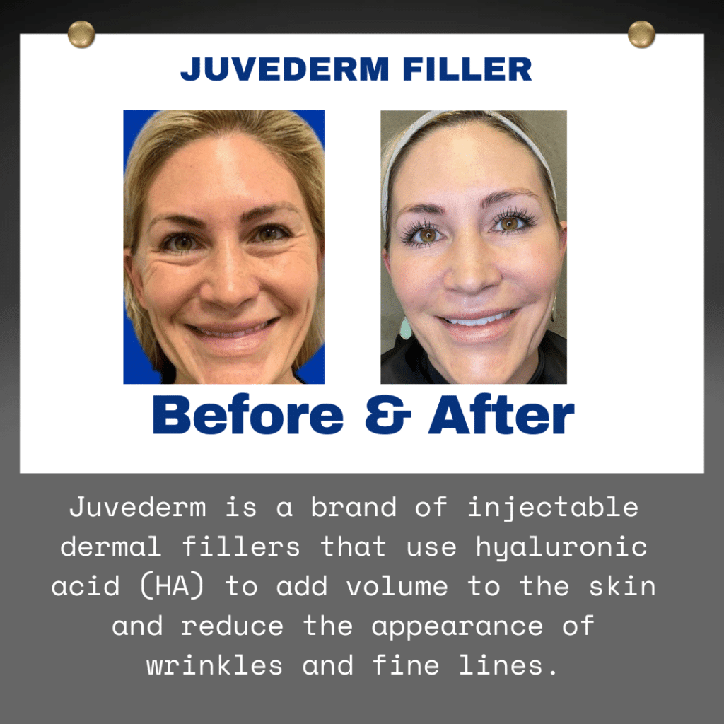 juvederm filler bella lei aesthetics 32003