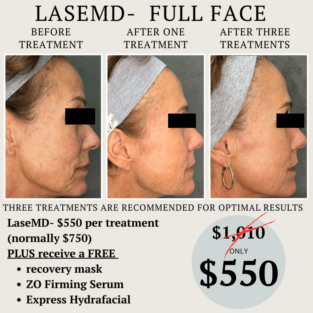 laser face treatment bella lei