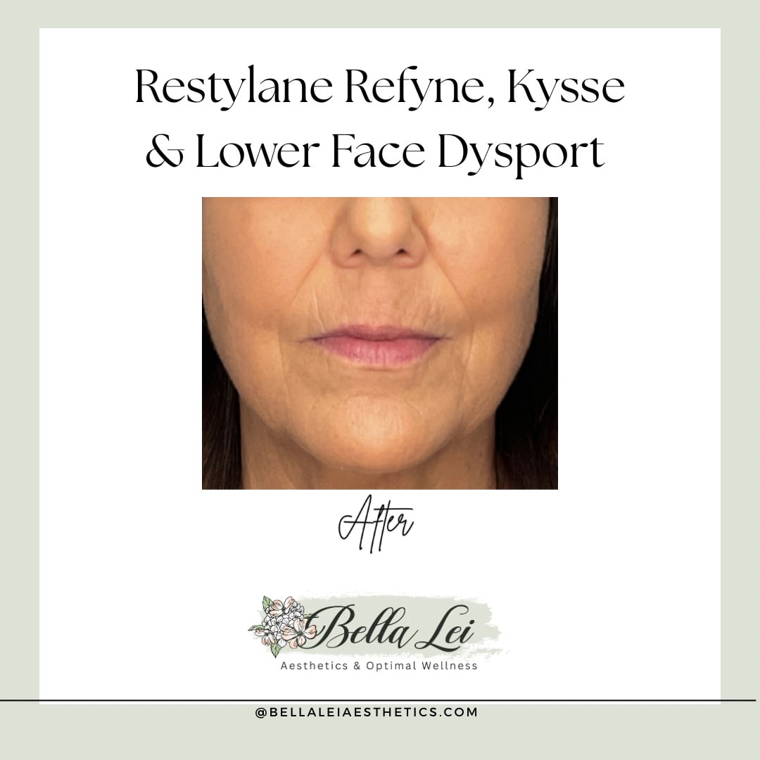 Restylane-Refyne-Kysse-do-Lower-Face-Dysport-After-photo-2-Bella-Lei-Aesthetics-Fleming-Island-Florida.jpg