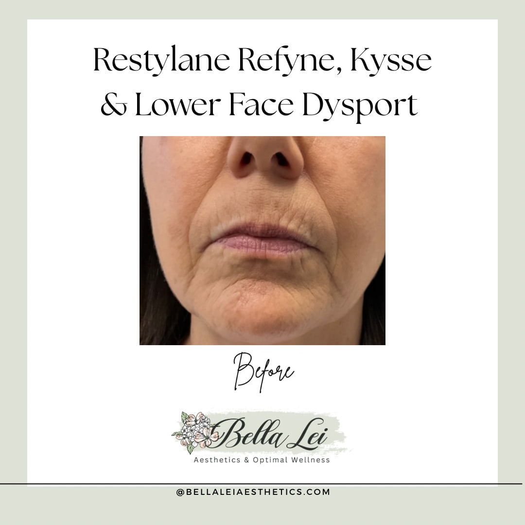 Restylane-Refyne-Kysse-do-Lower-Face-Dysport-Before-PHoto-2-Bella-Lei-Aesthetics-Fleming-Island-Florida.jpg